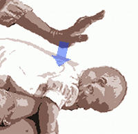 Atragantamiento en bebés: Golpes en la espalda