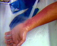 Quemaduras: Cómo tratar y curar quemaduras leves